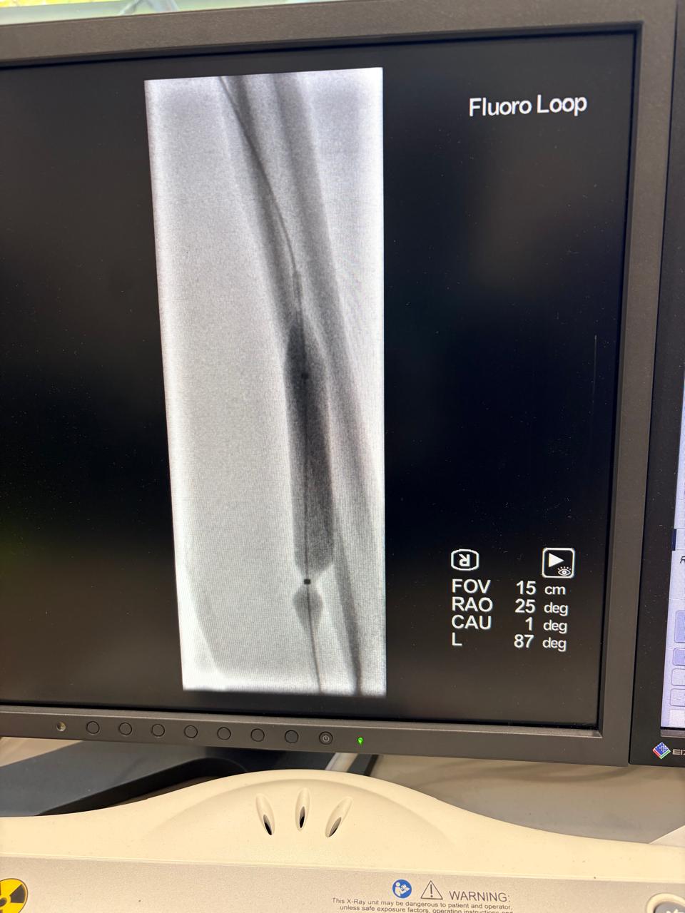 Balloon angioplasty